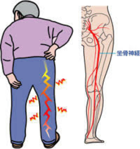 坐骨 神経痛 マッサージ